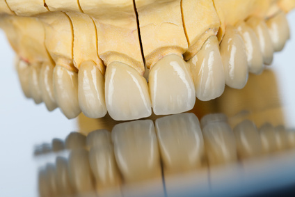 Ceramic teeth - dental bridge